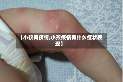 【小孩有疫情,小孩疫情有什么症状表现】